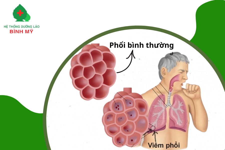 Nguyên nhân và các triệu chứng viêm phổi ở người già