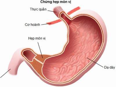 Chứng hẹp môn vị