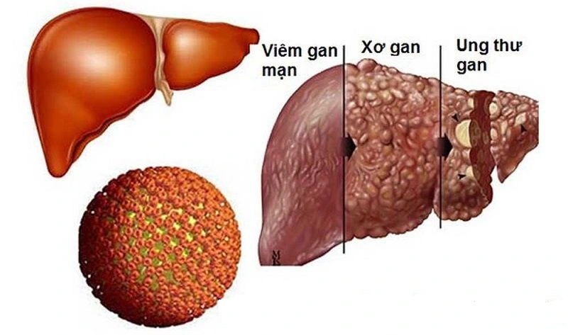 Bệnh gan mãn tính, bao gồm viêm gan B, viêm gan C và xơ gan
