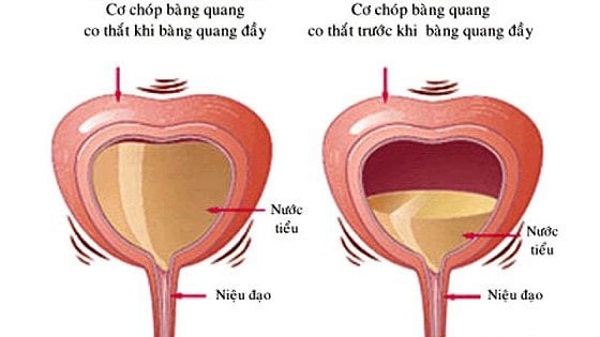 Bàng quang của người già bị suy giảm, làm mất đi sự linh hoạt và khả năng co bóp hiệu quả