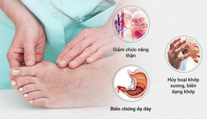 Điều trị và phòng ngừa bệnh gút ở người già