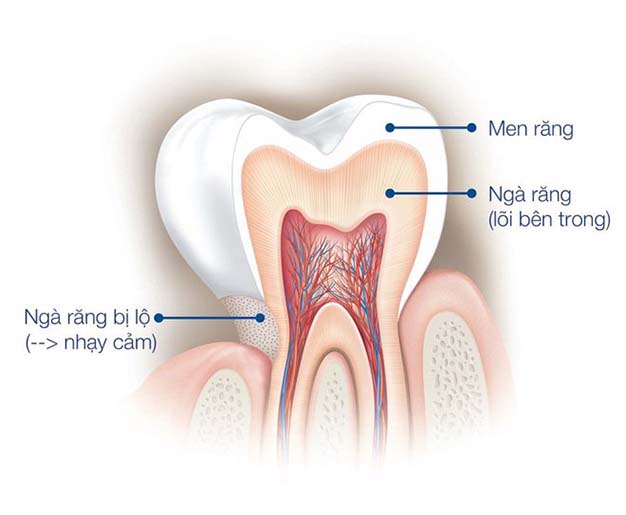 Mòn men răng là quá trình mất đi lớp men bảo vệ trên bề mặt răng, làm cho răng trở nên nhạy cảm và dễ bị tổn thương hơn