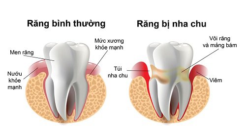 Viêm nha chu là một bệnh lý về nướu, xuất hiện khi có sự viêm nhiễm xảy ra ở các mô quanh răng