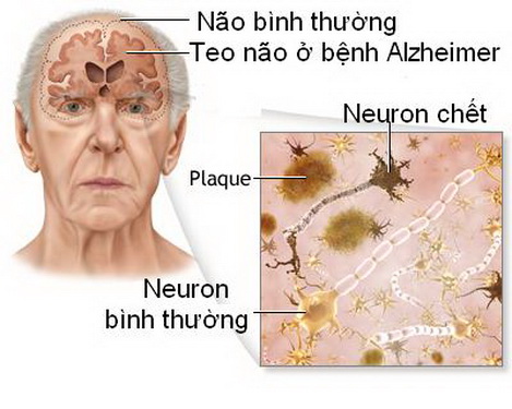 Suy giảm trí nhớ ở người cao tuổi có thể xuất phát từ nhiều nguyên nhân khác nhau