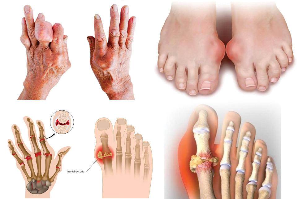 Bệnh gút (gout) là một dạng viêm khớp do sự tích tụ của các tinh thể urat trong khớp