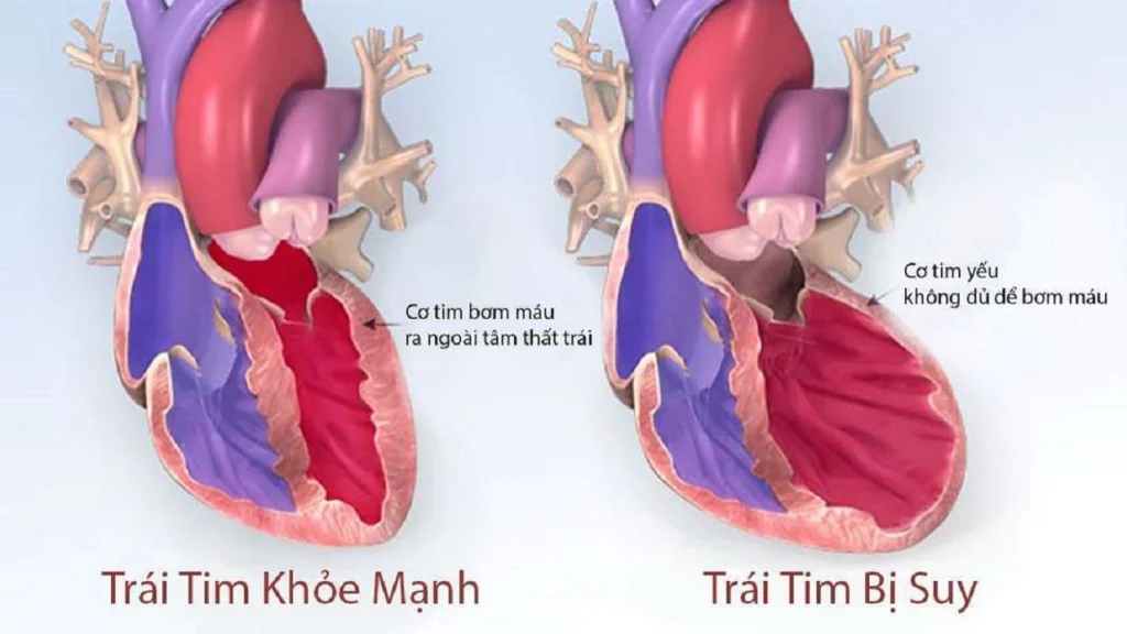 Cơ tim bị suy yếu