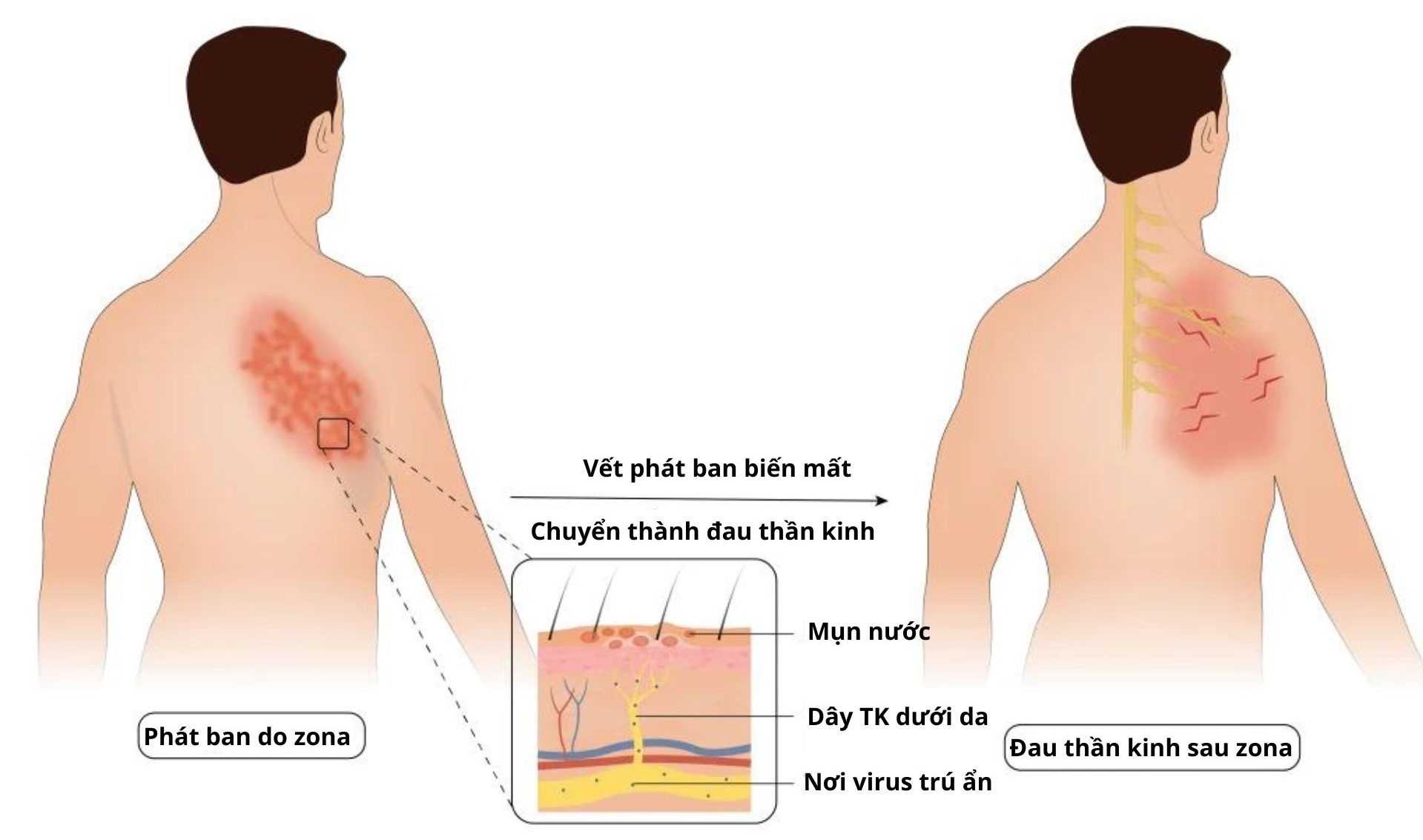 Đau dây thần kinh sau zona là tình trạng đau dai dẳng, kéo dài nhiều tháng, thậm chí cả năm sau khi mụn nước đã lành