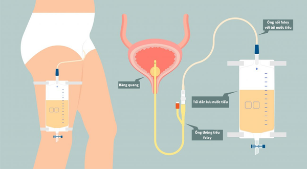 Tầm quan trọng của việc chăm sóc vệ sinh sonde tiểu cho người cao tuổi