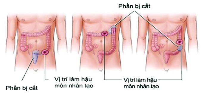 Hậu môn giả là một thiết bị y tế quan trọng, giúp người cao tuổi duy trì chức năng bài tiết và sinh hoạt hàng ngày