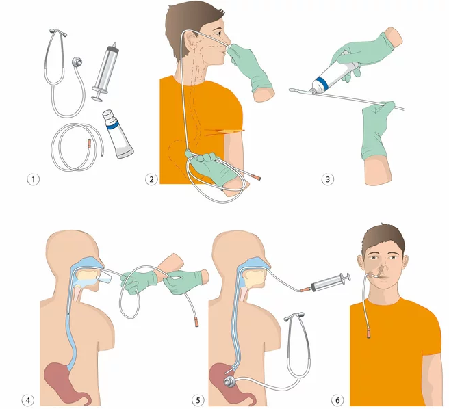 Kỹ thuật và cách thức thực hiện sonde ăn qua dạ dày