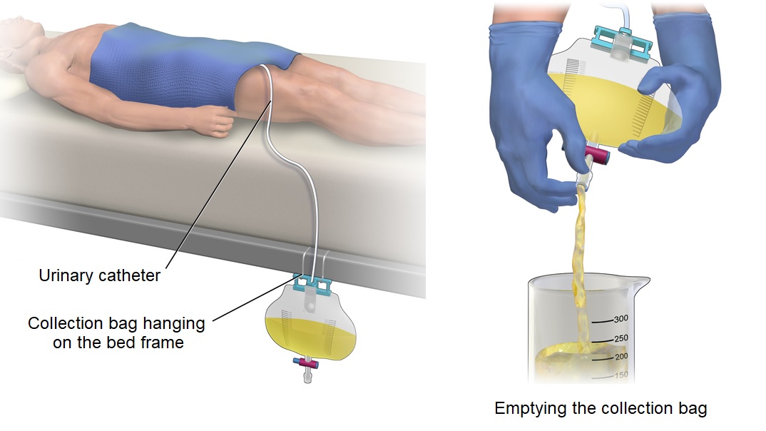 Hướng dẫn các bước vệ sinh sonde tiểu